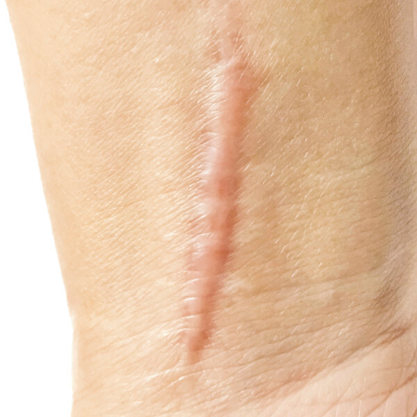 Hyperplastic Scars