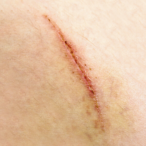 Surgical and Traumatic Scars